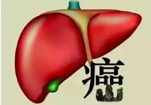 小肝癌是什么意思 小肝癌治愈后正常寿命