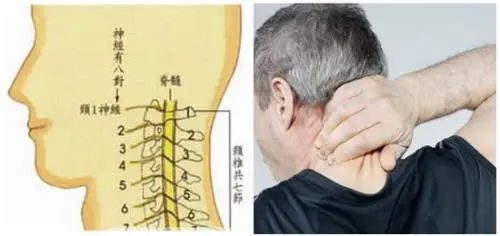 神经根型颈椎病是怎么回事儿?神经根型颈椎病能彻底治好吗