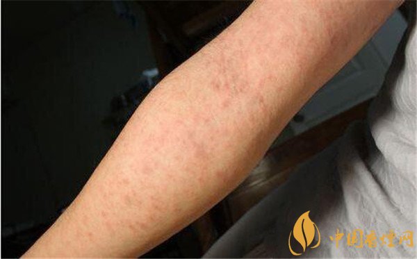 戒烟药畅沛副作用有哪些   戒烟药畅沛对人体的危害（有自杀风险）